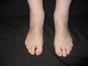 Ankle Joint Effusion (Anterior View): From the anterior perspective, swelling in the ankles is visible, with loss of the definition of the malleoli. (Image Credit: Ms. Nancy Roper)