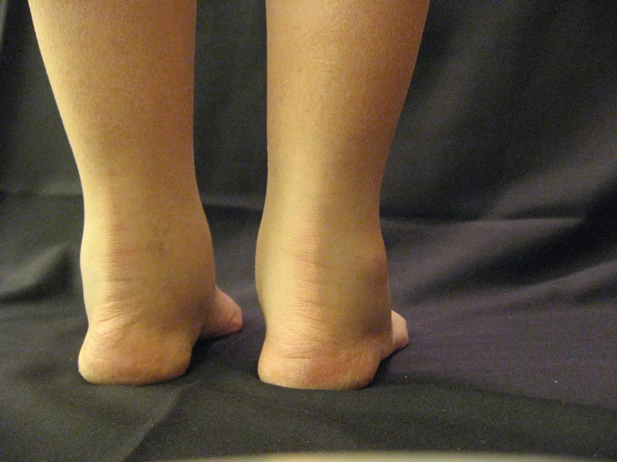 Ankle Joint Effusion (Posterior View)