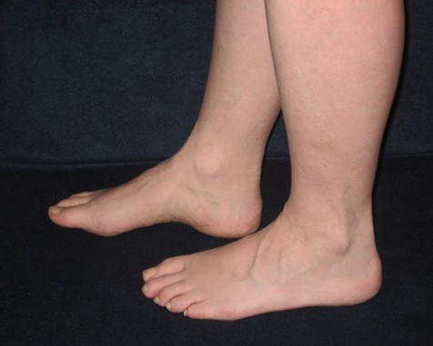 Normal Ankle (Lateral View) (Image Credit: Ms. Nancy Roper)