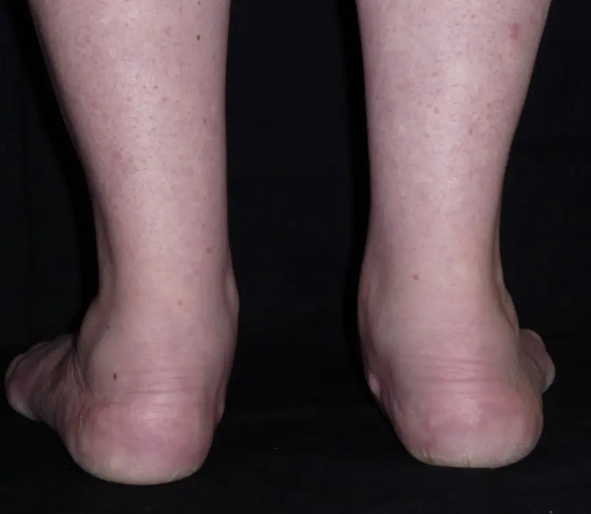 Pronation of Ankle