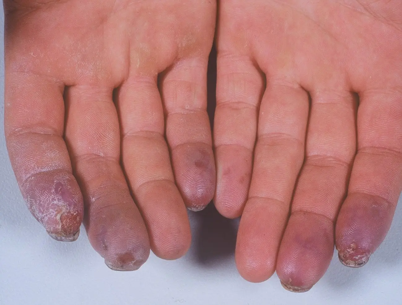Digital Vasculitis/ Vasculopathy/ Ischemia
