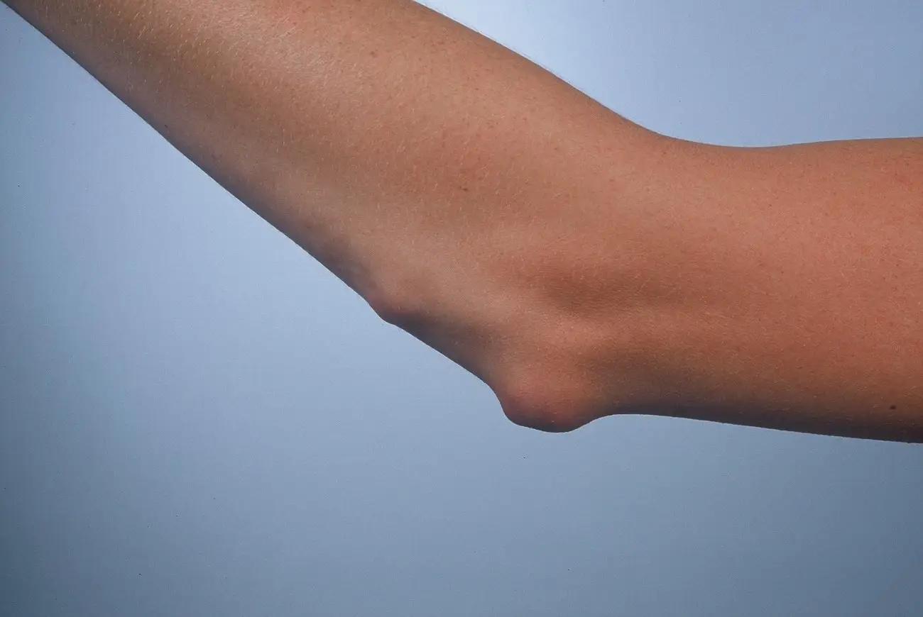 Rheumatoid Nodule in the Elbow