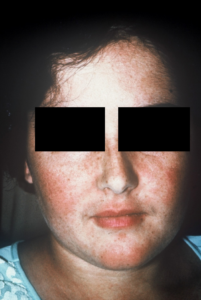Malar Rash (Lupus): This picture shows the malar rash of lupus with erythema sparing the nasolabial folds. (Image Credit: Dr. Jack Reynolds)