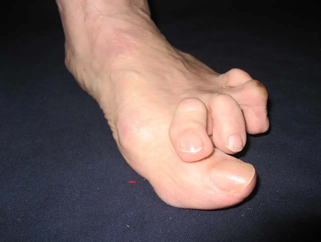 Crossover Toes