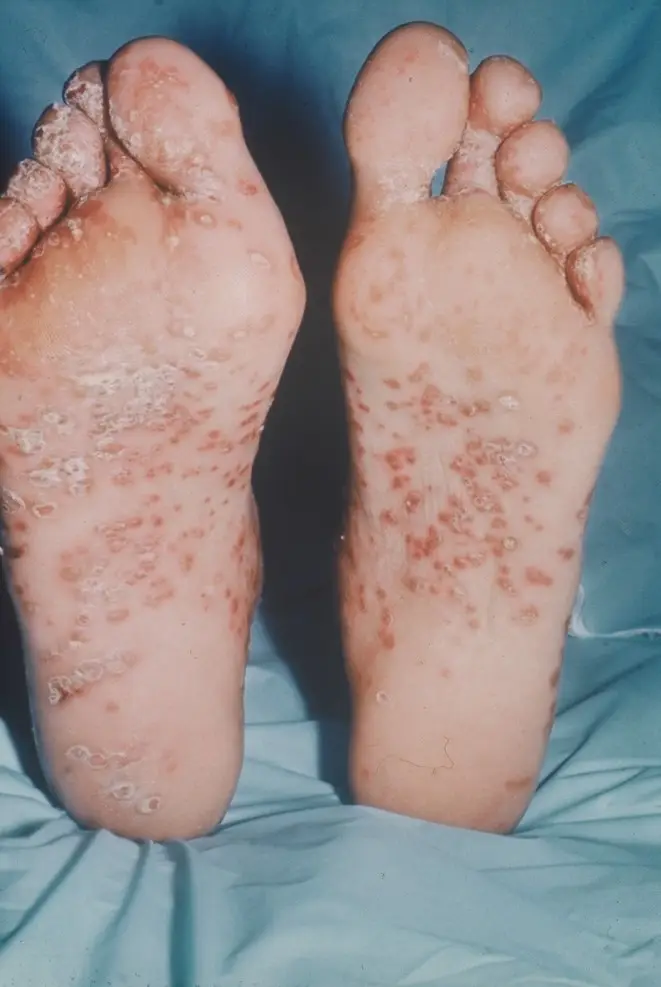 Keratoderma Blenorrhagicum