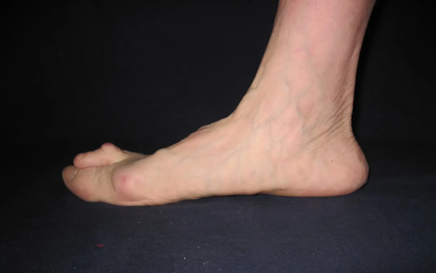 Pes Planus