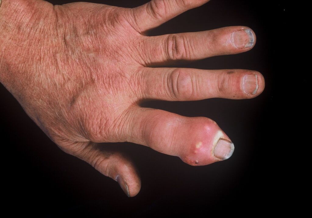 Tophus (Gout): In this picture, a single DIP is involved with dramatic swelling – it is too big to be OA alone. There is no other evidence for psoriatic arthritis. There is also the appearance of material extruding from under the skin– this is a tophus associated with gouty arthritis of the DIP joint. (Image Credit: Dr. Jack Reynolds)