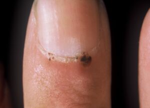 Connective Tissue Disease with Nailfold Change: This finger shows nailfold changes with hemorrhages/infarcts suggesting small vessel vasculitis/vasculopathy. This might be seen in connective tissue diseases such as lupus and dermatomyositis. (Image Credit: Dr. Jack Reynolds)