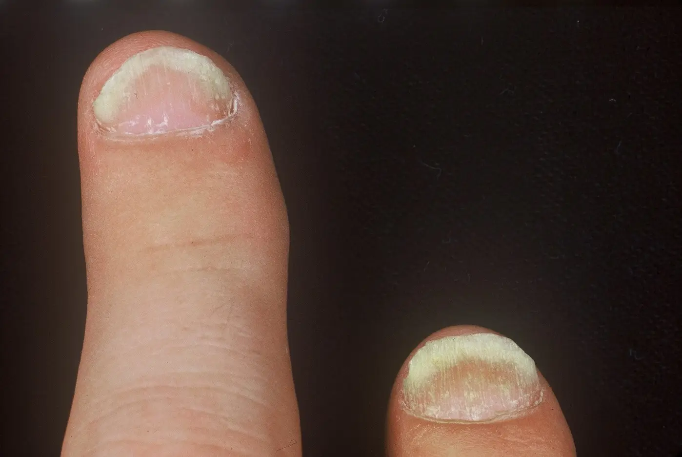 Onycholysis (Psoriatic Arthritis of Nails)