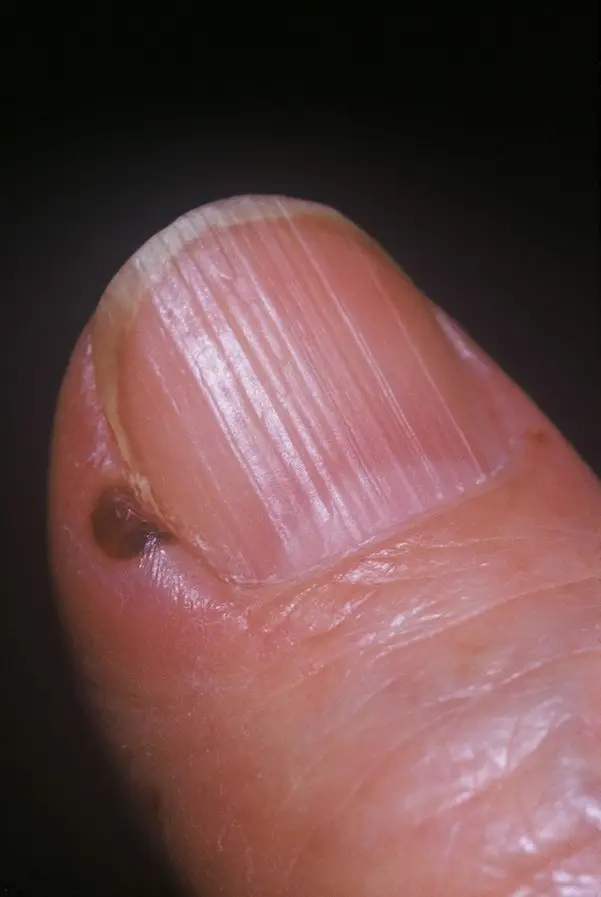 Small Vessel Vasculitis with Nailfold Change