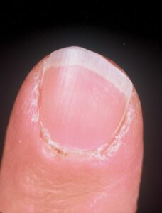 Connective Tissue Disease with Nailfold Change: These fingers show a more subtle vasculopathy at the nailfold with erythema and some small dilated vessels that look like “red dots” in the nailfold. Note that roughened cuticles may be seen as part of this process. (Image Credit: Dr. Jack Reynolds)