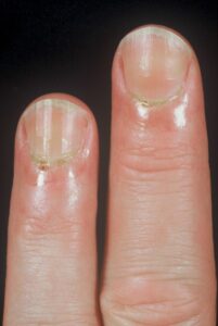 Connective Tissue Disease with Nailfold Change: These fingers show a more subtle vasculopathy at the nailfold with erythema and some small dilated vessels that look like “red dots” in the nailfold. (Image Credit: Ms. Nancy Roper)