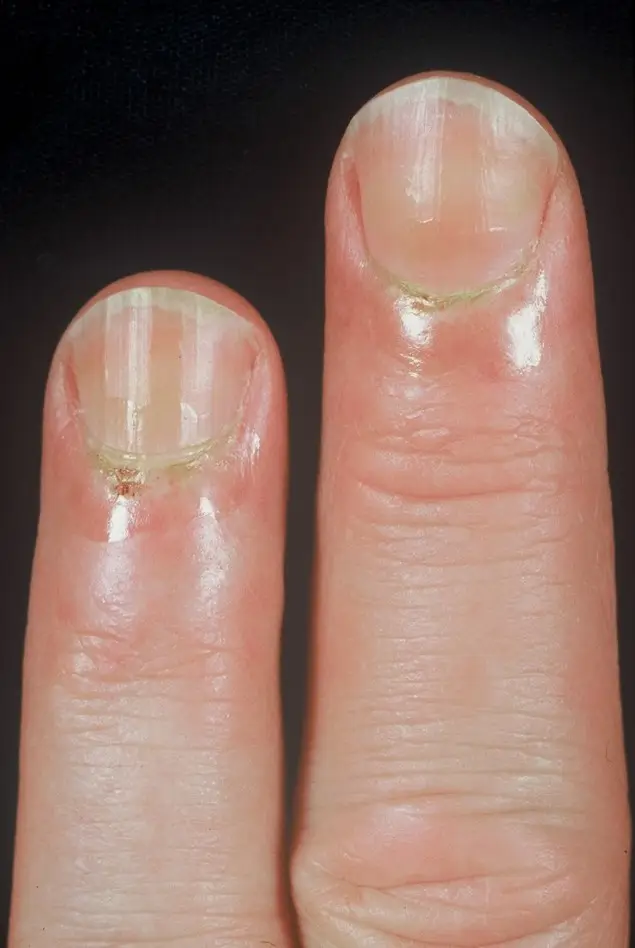 Connective Tissue Disease with Nailfold Change
