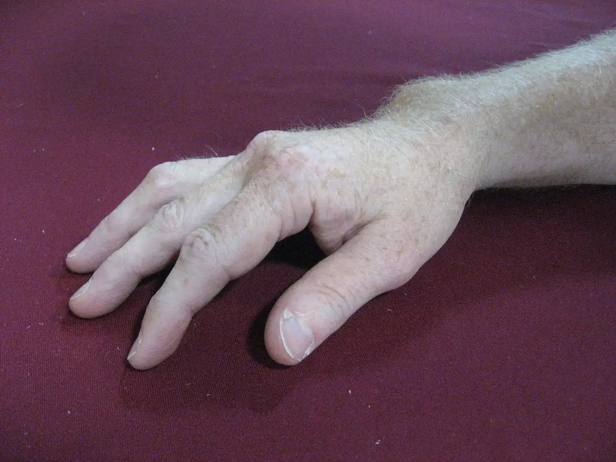 Volar Subluxation