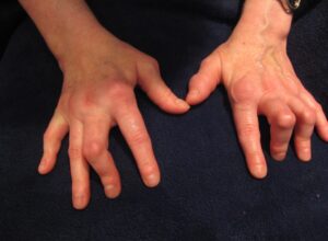 Boutonniere Deformity: These hands show other chronic changes of inflammatory arthritis- Boutonniere deformities are affecting the right 3rd and 5th and left 3rd and 4th digits. (Image Credit: Ms. Nancy Roper)