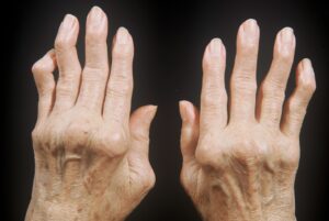 Inflammatory Arthritis: There are classic changes of longstanding rheumatoid arthritis to be seen here. Can you name them? Subluxation of MCPs, swan neck deformities (4th and 5th digits bilaterally). (Image Credit: Dr. Jack Reynolds)