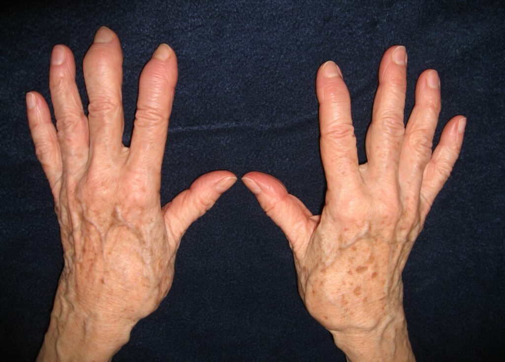 Osteoarthritis: Significant DIP swelling is seen in an asymmetric distribution in these hands. This looks similar to what might be seen in psoriatic arthritis. However, the changes at the base of the thumbs (squaring and subluxation) indicates that this is most likely osteoarthritis. (Image Credit: Ms. Nancy Roper)