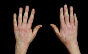 Dermatomyositis: These hands show the classic rash of dermatomyositis with scaling rash over the MCPs and DIPs of the hands. (Image Credit: Dr. Jack Reynolds)