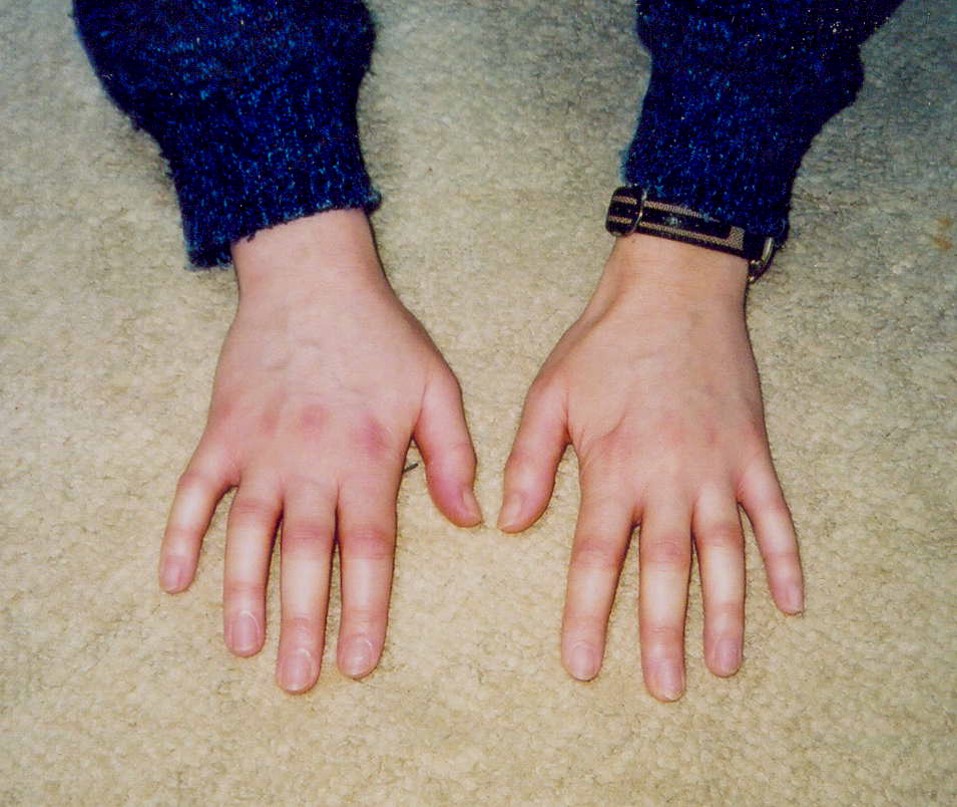 Inflammatory Arthritis (Before Treatment): This third set of hands demonstrates widespread effusions in PIPS and MCPs producing puffy digits. There is mild erythema over the inflamed joints. The right wrist is swollen as well. This is typical of early rheumatoid arthritis or the arthritis associated with collagen vascular diseases. (Image Credit: Ms. Nancy Roper)
