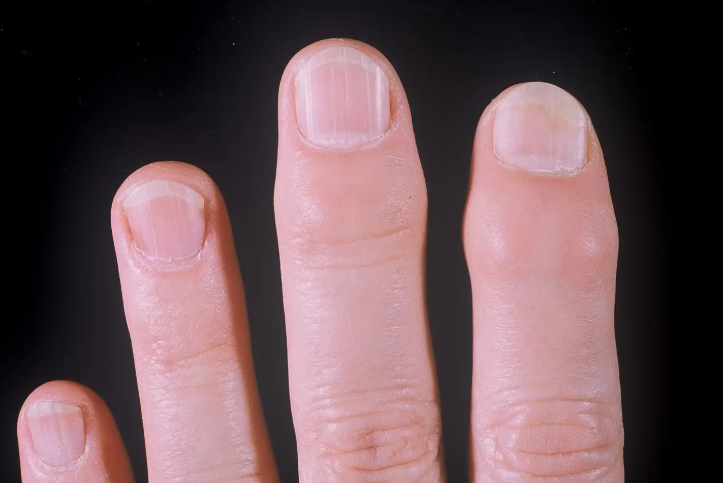 Psoriatic Arthritis in the Fingers