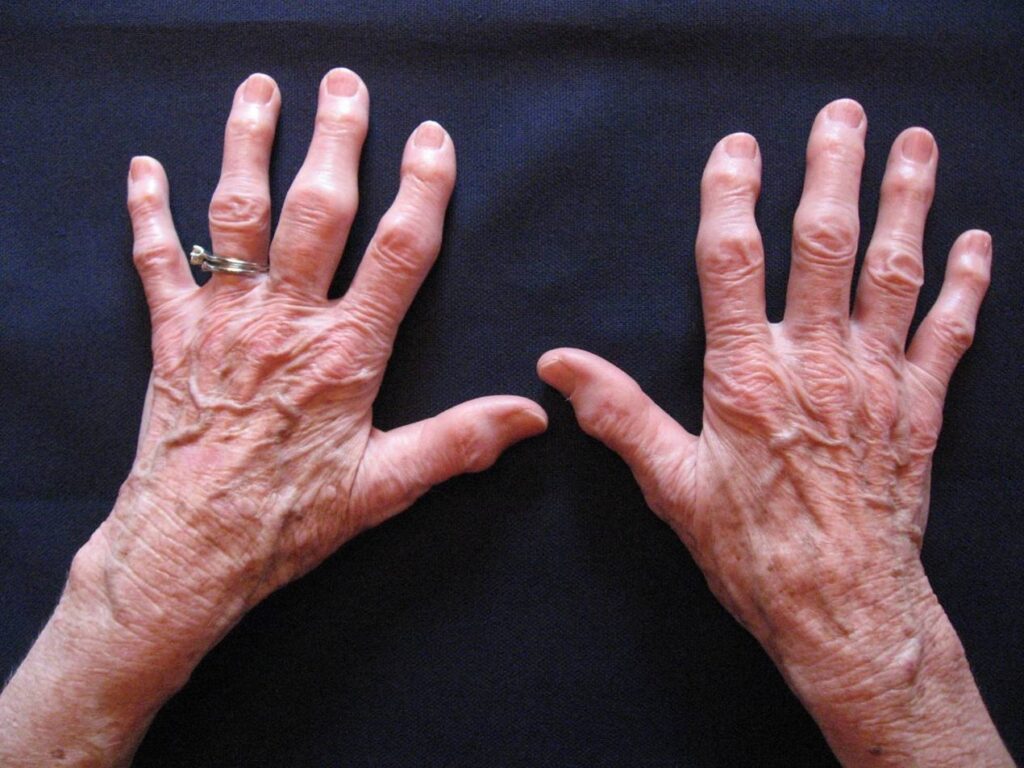 Osteoarthritis: Here we see enlargement of the DIP joints. It is fairly uniform, and we also can appreciate some enlargement of the PIP joints in many digits. This swelling looks more “hard” and nodular (however, palpation will be needed to confirm this). (Image Credit: Dr. Jack Reynolds)