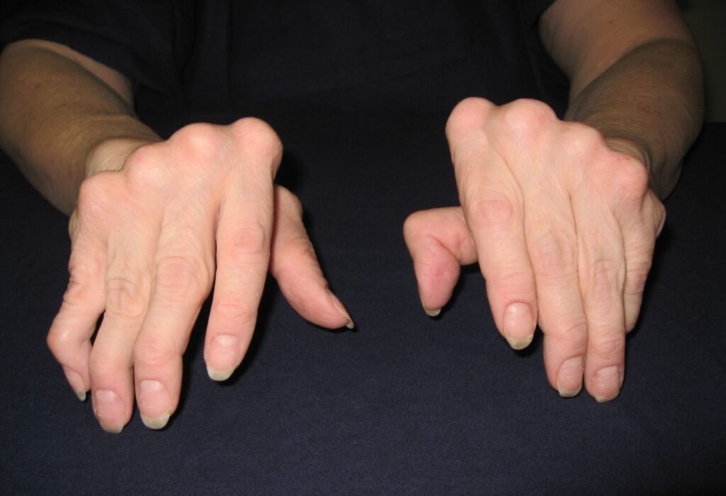 Typical Ulnar Deviation of Rheumatoid Arthritis (Pronation) (Image Credit: Ms. Nancy Roper)