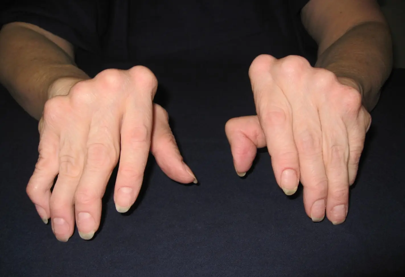 Typical Ulnar Deviation of Rheumatoid Arthritis in the Hand (Pronation)