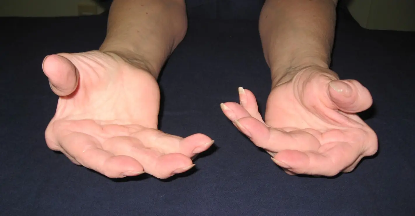 Typical Ulnar Deviation of Rheumatoid Arthritis in the Hand (Supination)