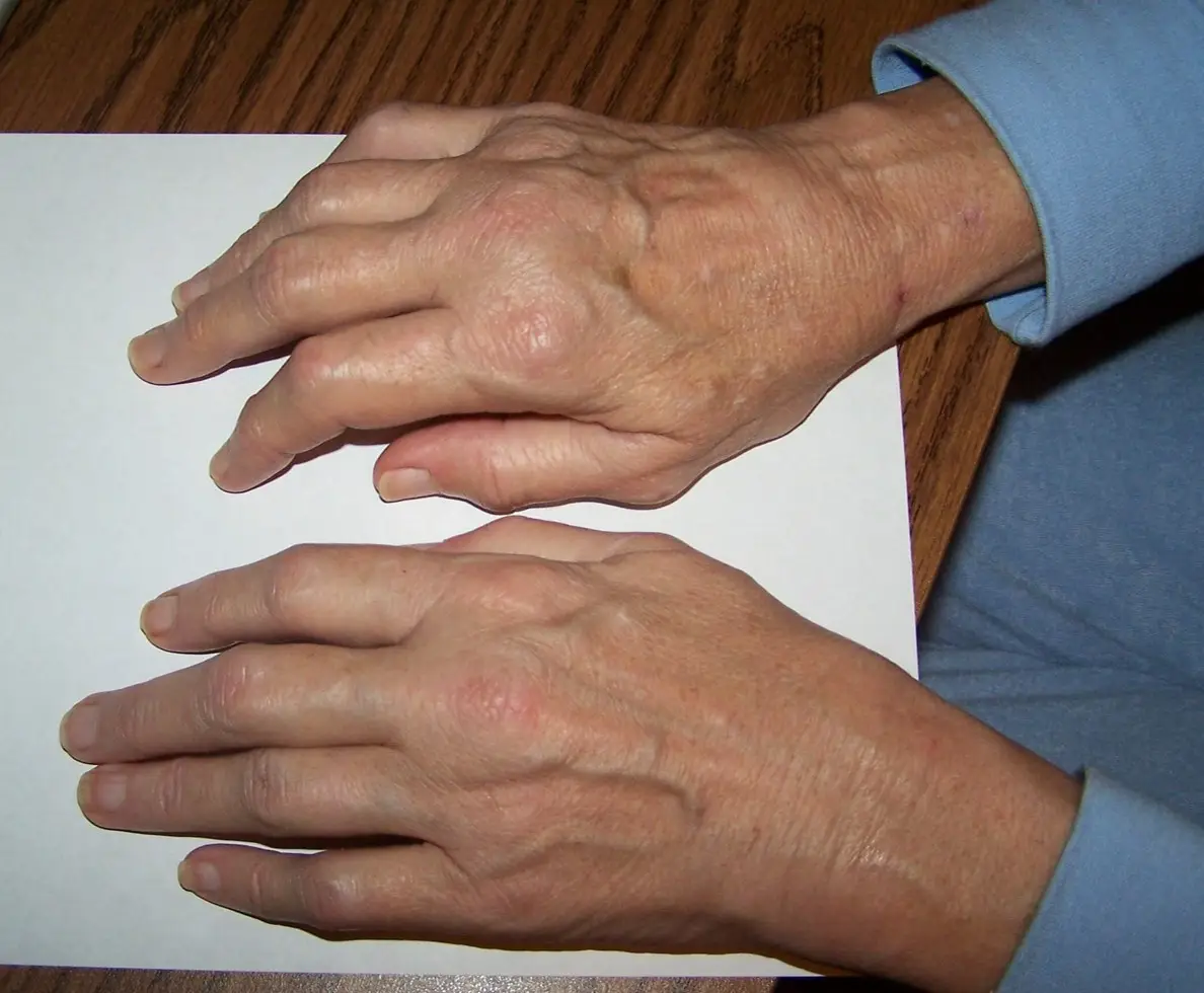 Early Changes of Inflammatory Arthritis in the Hand