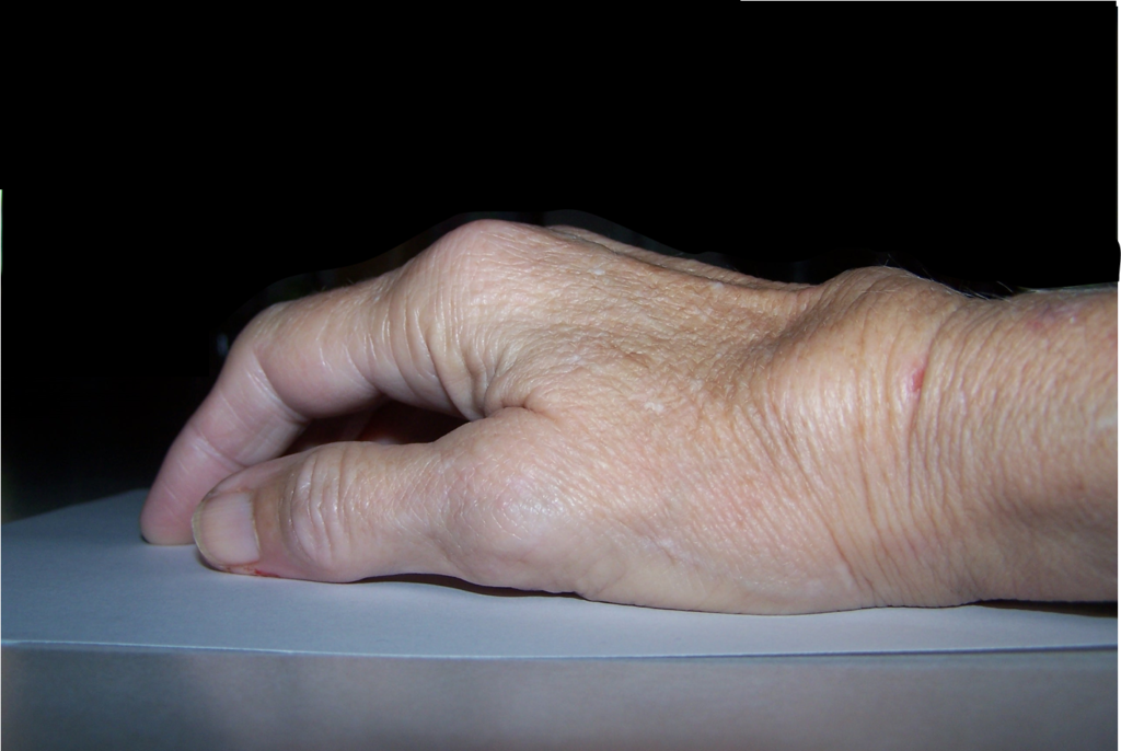 Early Changes of Inflammatory Arthritis: This picture shows another view of the swelling in the right wrist. There is fluid in the dorsal tenosynovial sheath producing a “tuck sign” (rather than diffuse swelling, the swelling bunches up on the dorsum of the wrist, especially with finger extension). This is usually painless compared with a wrist effusion. (Image Credit: Dr. Lori Albert)