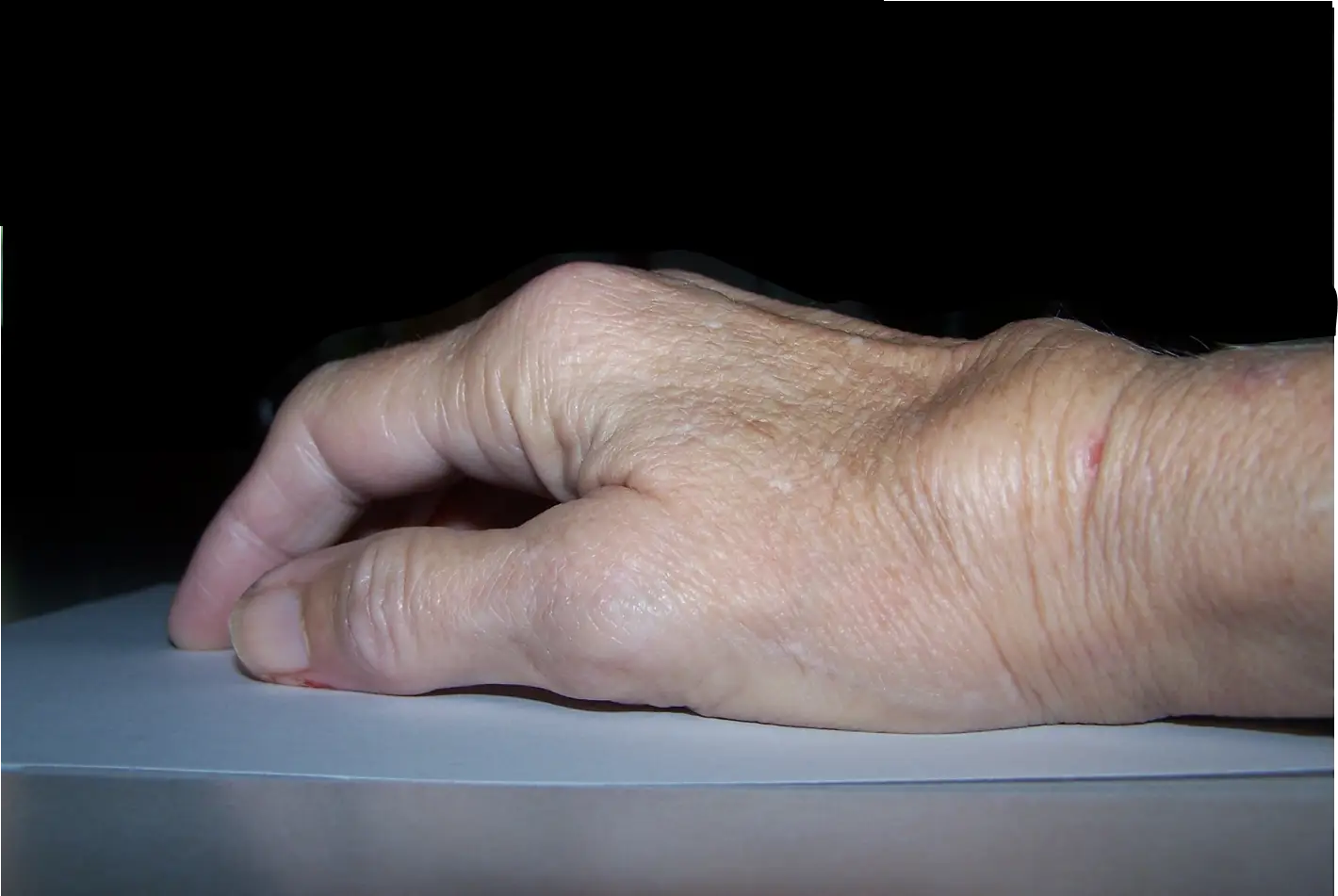 Early Changes of Inflammatory Arthritis in the Hand