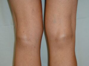 Baker's (Popliteal) Cyst (Posterior View): Observation of the knees from the posterior aspect reveals a well-circumscribed fullness in the popliteal fossa. (Image Credit: Dr. Lori Albert)