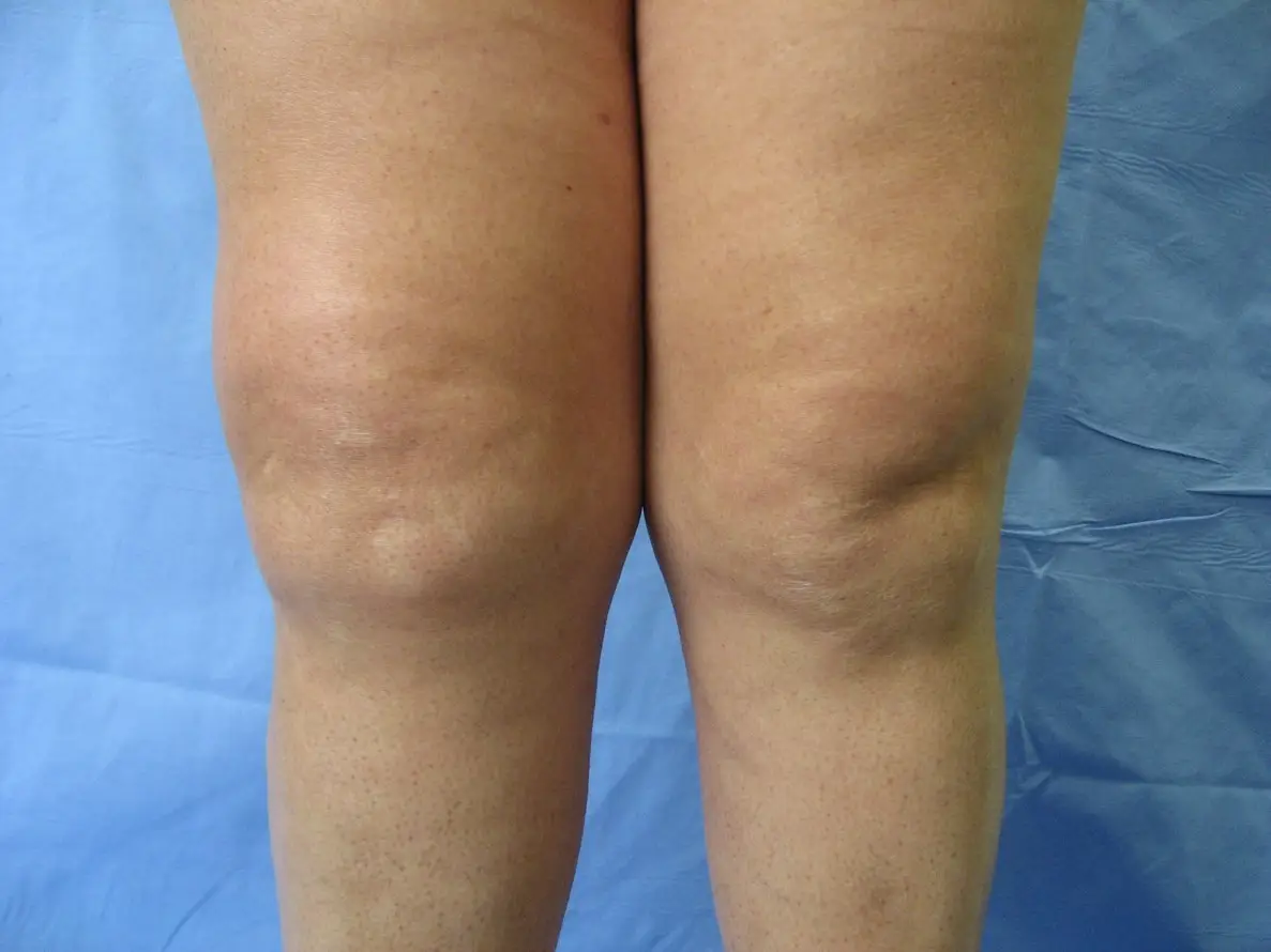 Knee Effusion