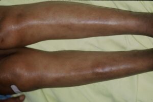 Erythemanodosum: On the anterior aspect of the legs large, bruise-like lesions are visible- erythema nodosum (often associated with inflammatory synovitis in knees and ankles as part of acute sarcoidosis). (Image Credit: Dr. Jack Reynolds)