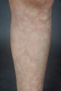 Livedo Reticularis: This shows the lacy-like rash of livedo reticularis- may be part of a vasculitis picture, especially if there are ulcerations and if it is widespread. Sometimes can be seen as a benign rash in patients with lupus, antiphospholipid antibody syndrome and without associated disease. (Image Credit: Dr. Jack Reynolds)