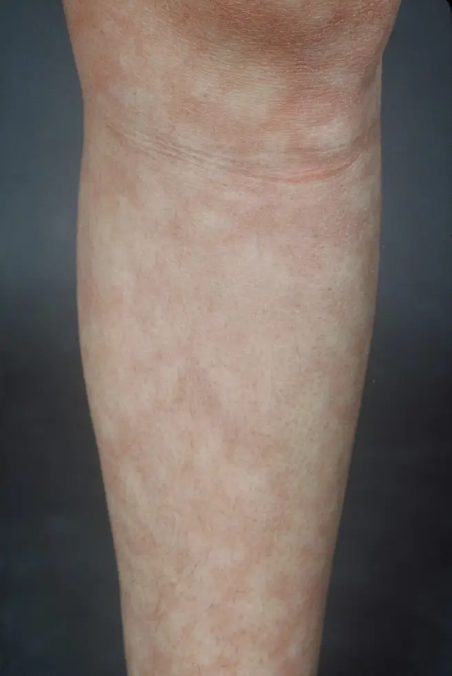Livedo Reticularis