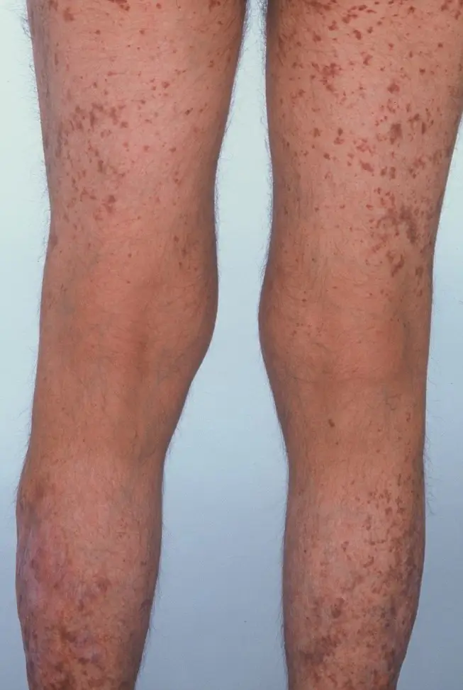 Palpable Purpura