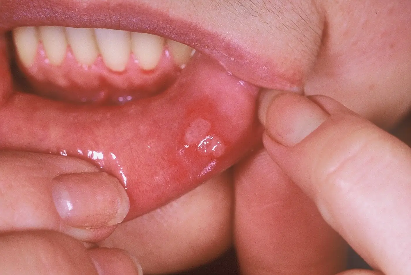 Mucosal Ulcer