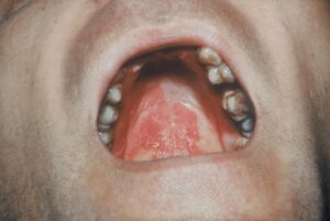 Oral Ulcer: This picture shows oral ulcerations affecting the hard palate. These can be seen in lupus but also in reactive arthritis. (Image Credit: Dr. Jack Reynolds)
