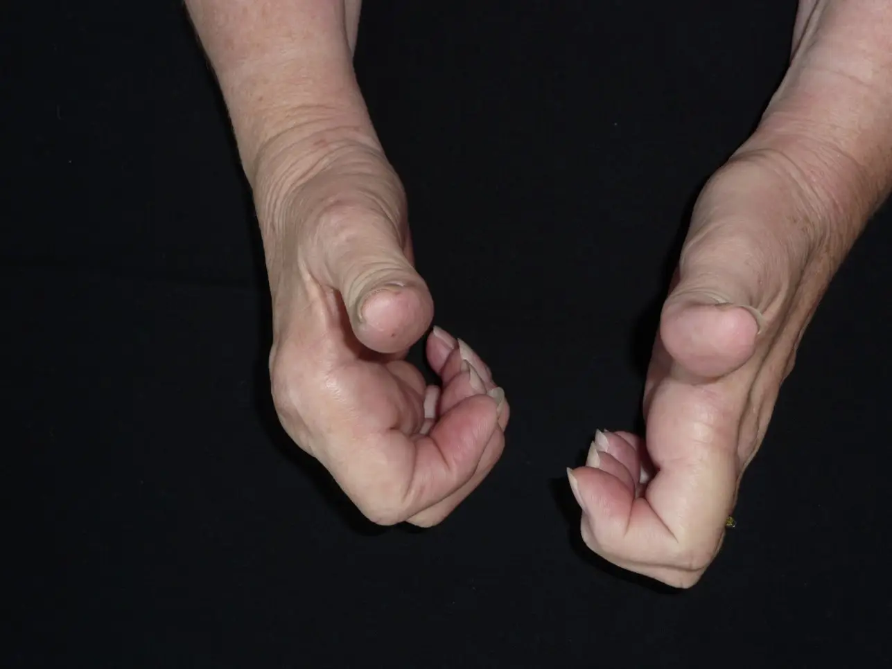 Inflammatory Arthritis in the Hand
