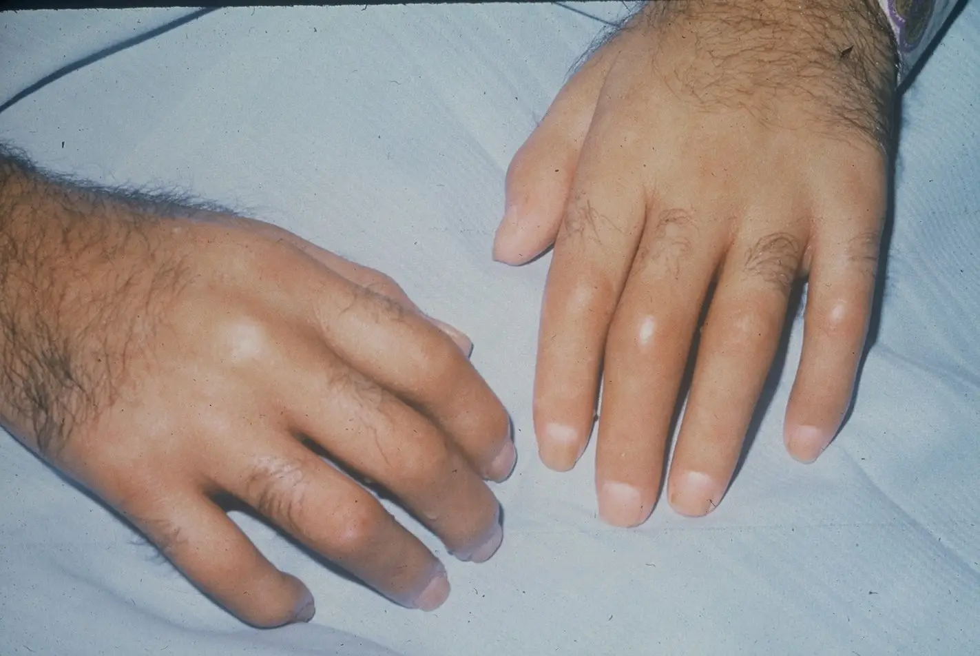 Sclerodactyly (Scleroderma)