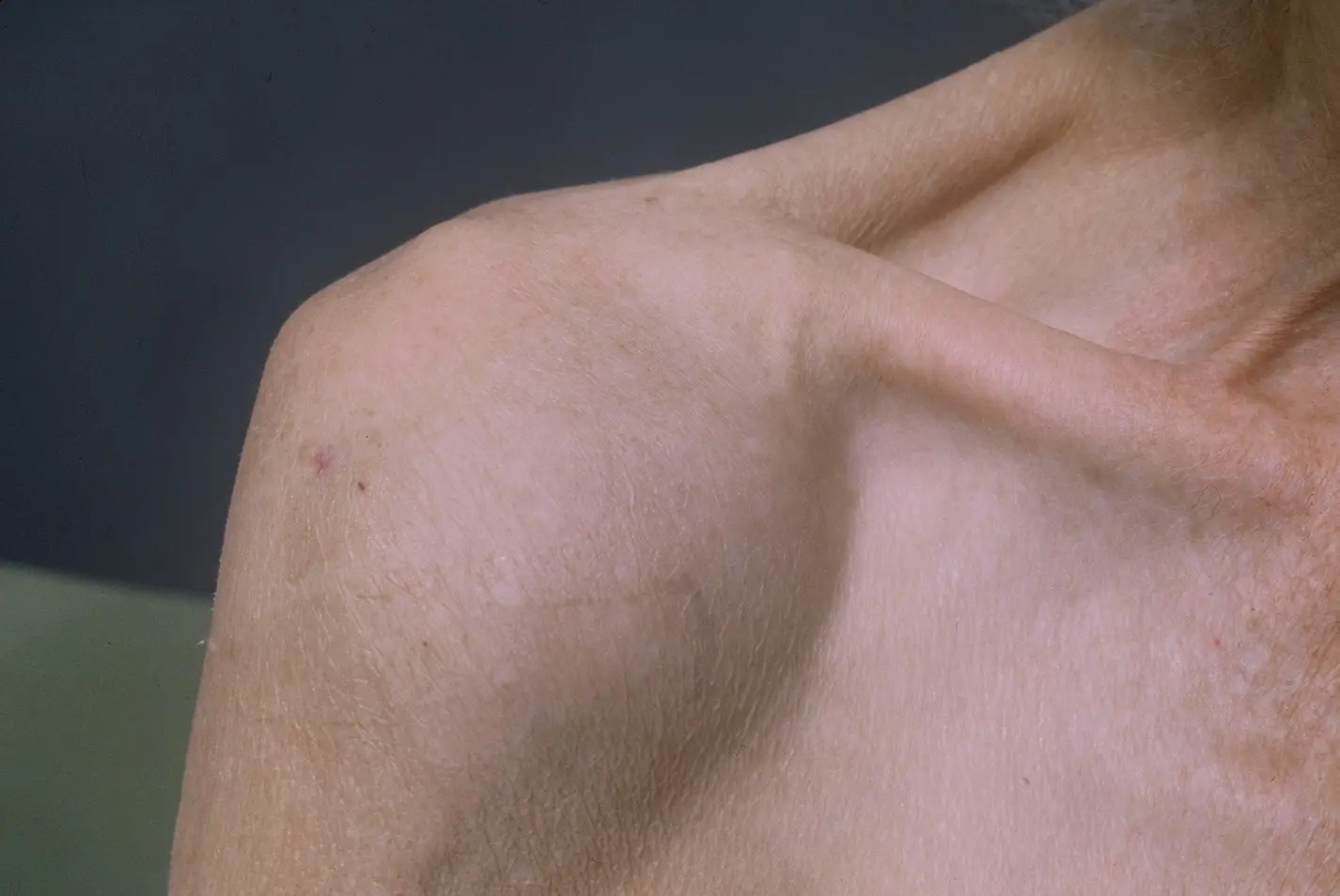 Shoulder Effusion