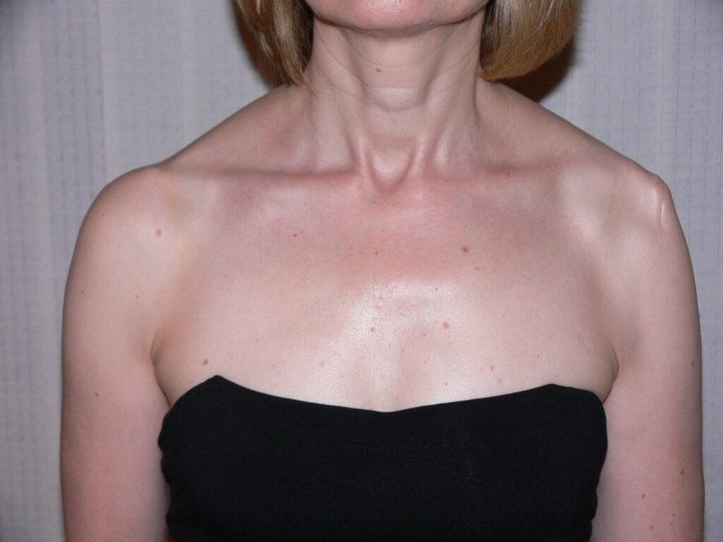 Muscle Atrophy of Shoulder (Anterior View): This picture shows muscle wasting around the left shoulder with loss of anterior deltoid fibers. (Image Credit: Ms. Nancy Roper)