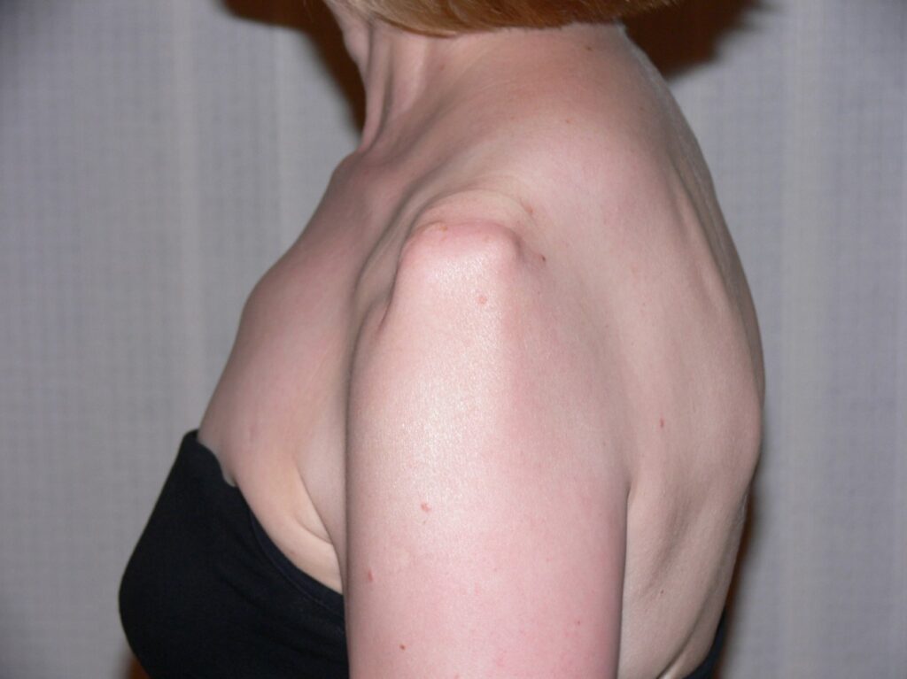 Muscle Atrophy of Shoulder (Lateral View): This picture shows muscle wasting around the left shoulder with loss of anterior deltoid fibers. (Image Credit: Ms. Nancy Roper)
