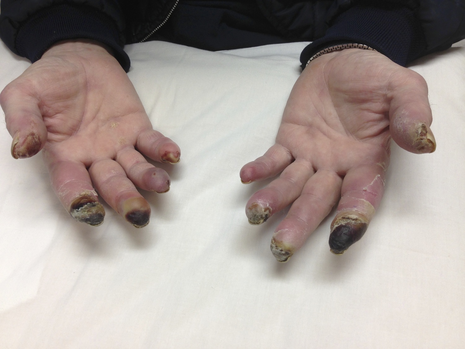 Buerger's disease (Thrombangitis Obliterans): This patient has Thrombangitis obliterans ( Buerger’s disease), a non-atherosclerotic, segmental, inflammatory disease that affects the small to medium-sized arteries and veins of the hands and feet that is closely associated with smoking. It is not a true vasculitis, rather, there are inflammatory occlusive thrombi found in the affected vessels. (Image Credit: Dr. Lori Albert)