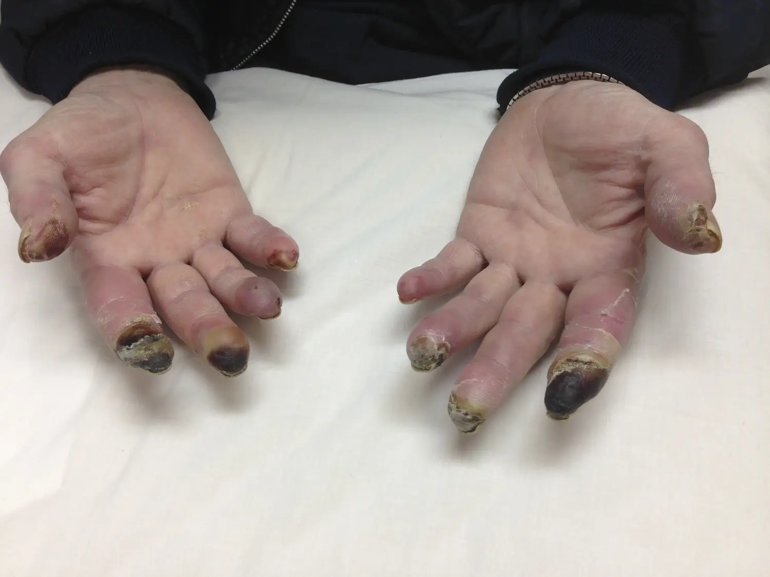 Buerger’s disease (Thrombangitis Obliterans)