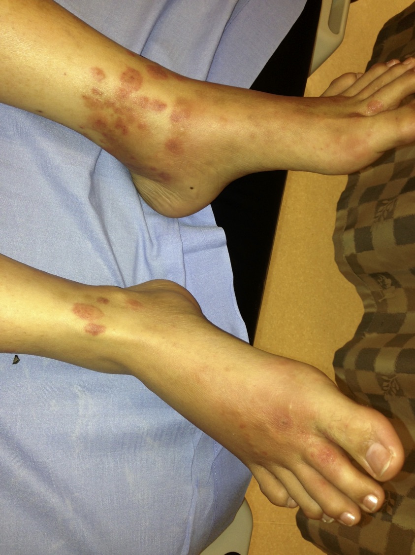 Palpable Vasculitis: This patient with lupus has a palpable (small vessel) vasculitis on the legs. (Image Credit: Dr. Lori Albert)