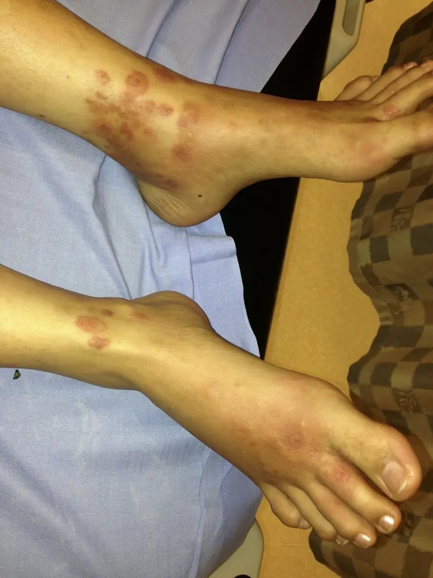 Palpable Vasculitis