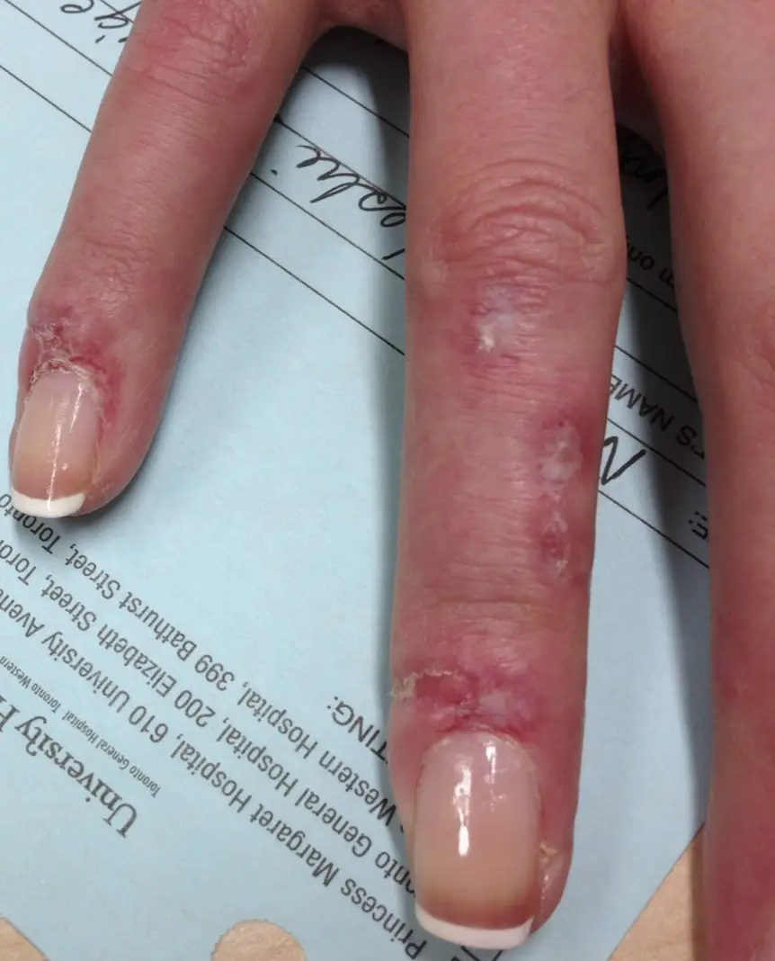 Lupus Vasculitis