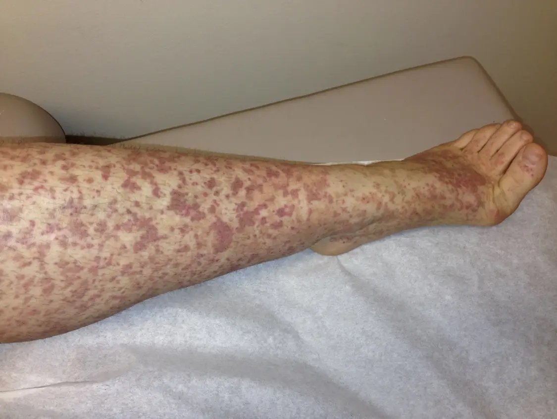 Palpable Purpura